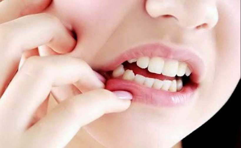 Cara Menyembuhkan Sakit Gigi Dengan Mudah